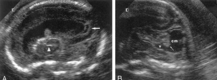 Calcificação intraventricular